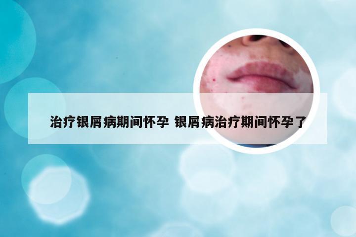 治疗银屑病期间怀孕 银屑病治疗期间怀孕了