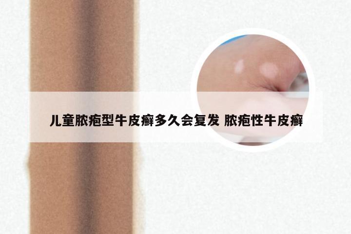 儿童脓疱型牛皮癣多久会复发 脓疱性牛皮癣