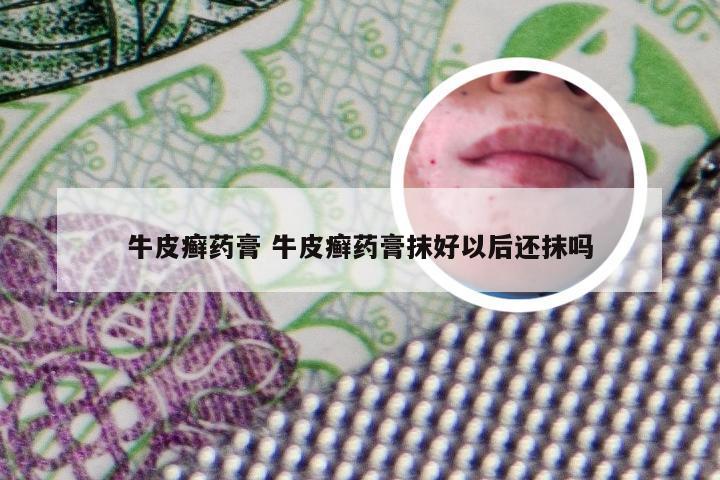 牛皮癣药膏 牛皮癣药膏抹好以后还抹吗