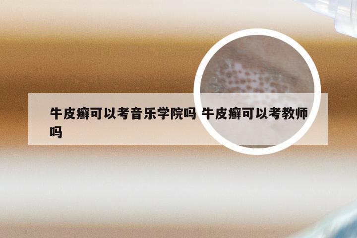 牛皮癣可以考音乐学院吗 牛皮癣可以考教师吗