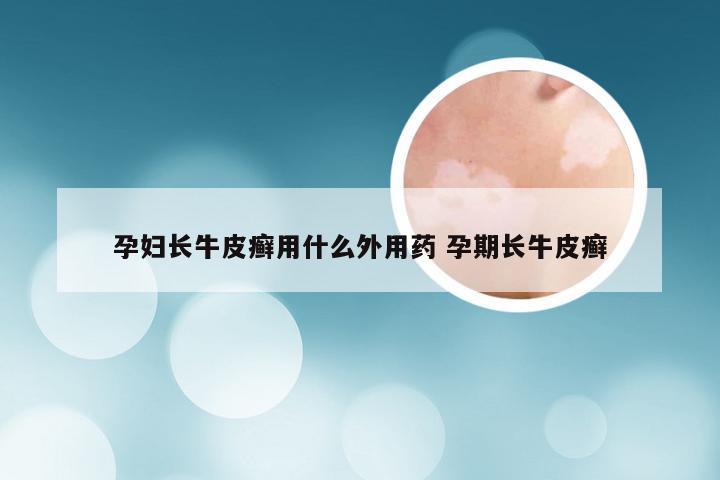 孕妇长牛皮癣用什么外用药 孕期长牛皮癣