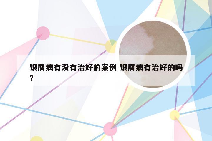 银屑病有没有治好的案例 银屑病有治好的吗?