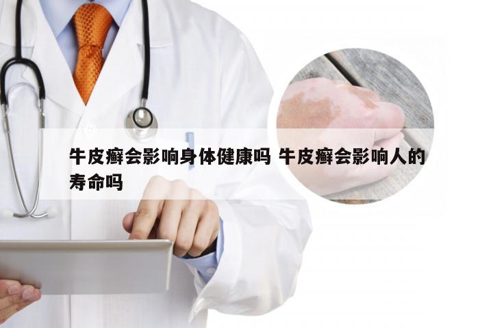 牛皮癣会影响身体健康吗 牛皮癣会影响人的寿命吗