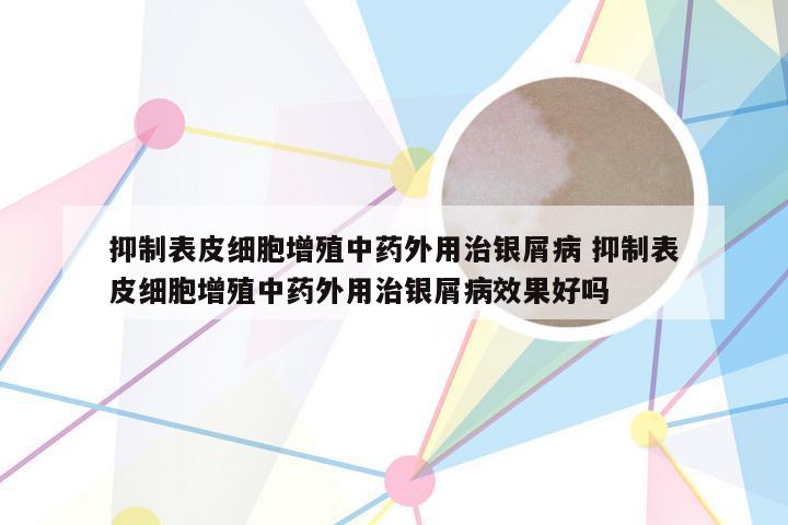 抑制表皮细胞增殖中药外用治银屑病 抑制表皮细胞增殖中药外用治银屑病效果好吗