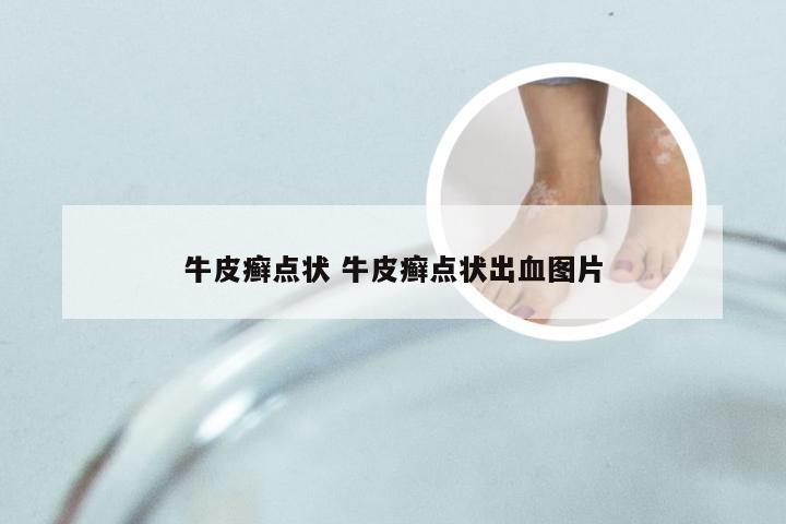 牛皮癣点状 牛皮癣点状出血图片