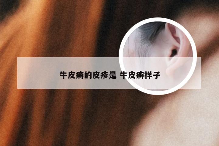 牛皮癣的皮疹是 牛皮癣样子
