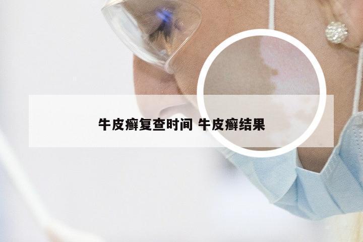 牛皮癣复查时间 牛皮癣结果