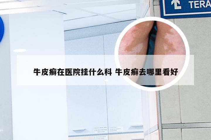 牛皮癣在医院挂什么科 牛皮癣去哪里看好
