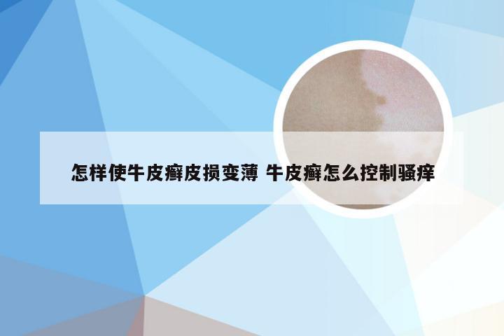 怎样使牛皮癣皮损变薄 牛皮癣怎么控制骚痒