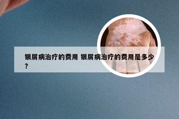 银屑病治疗的费用 银屑病治疗的费用是多少?