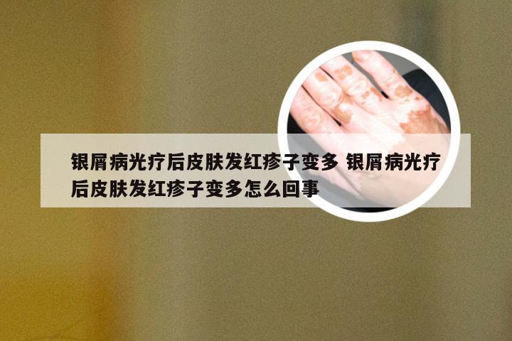 银屑病光疗后皮肤发红疹子变多 银屑病光疗后皮肤发红疹子变多怎么回事