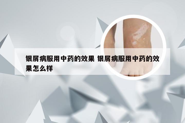 银屑病服用中药的效果 银屑病服用中药的效果怎么样