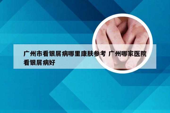 广州市看银屑病哪里康肤参考 广州哪家医院看银屑病好
