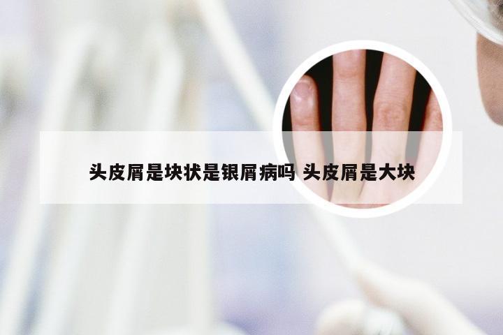 头皮屑是块状是银屑病吗 头皮屑是大块