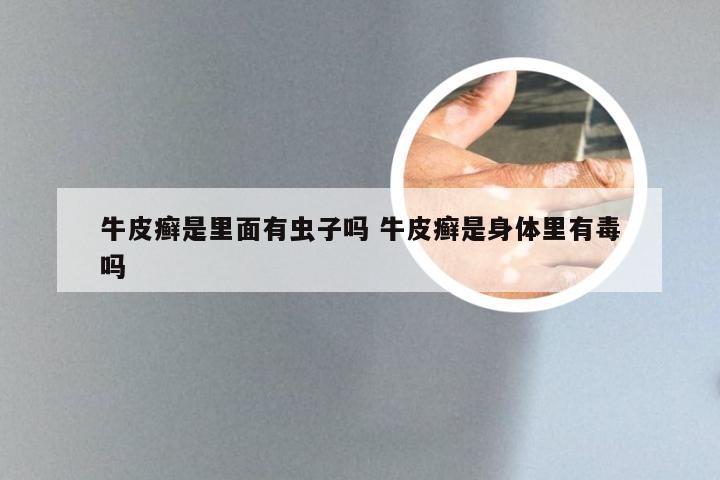 牛皮癣是里面有虫子吗 牛皮癣是身体里有毒吗