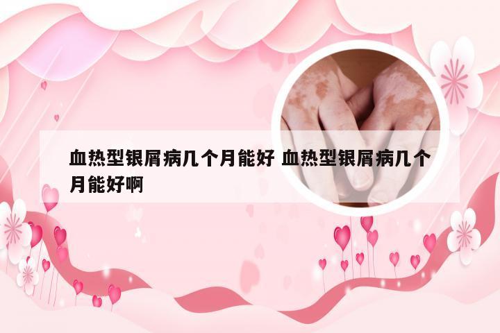 血热型银屑病几个月能好 血热型银屑病几个月能好啊