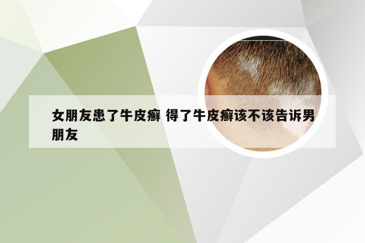 女朋友患了牛皮癣 得了牛皮癣该不该告诉男朋友