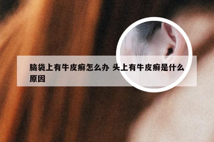 脑袋上有牛皮癣怎么办 头上有牛皮癣是什么原因
