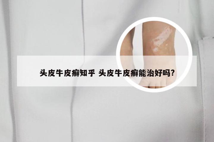头皮牛皮癣知乎 头皮牛皮癣能治好吗?