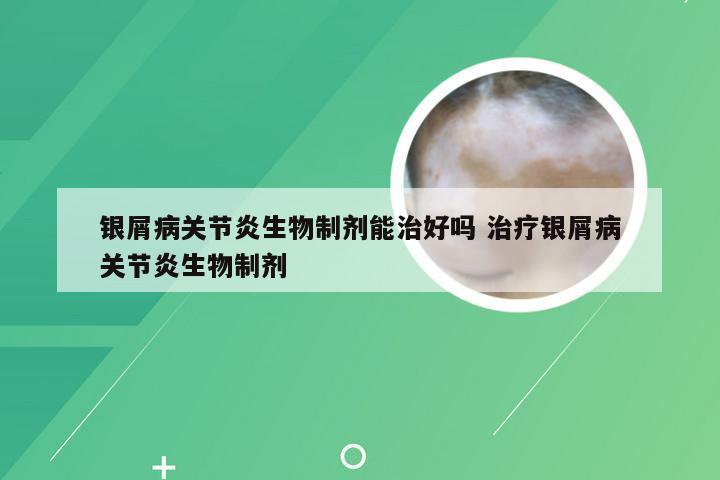 银屑病关节炎生物制剂能治好吗 治疗银屑病关节炎生物制剂