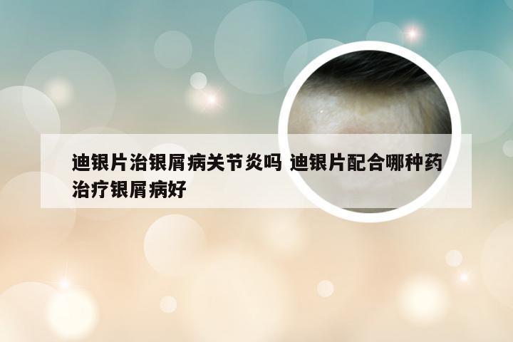 迪银片治银屑病关节炎吗 迪银片配合哪种药治疗银屑病好