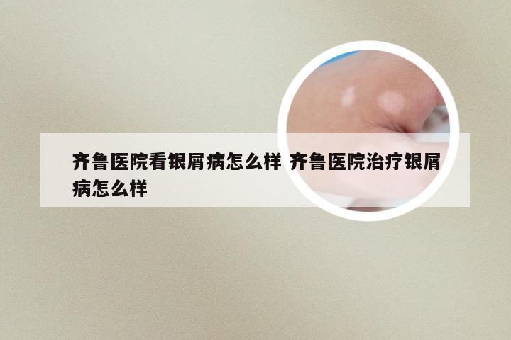 齐鲁医院看银屑病怎么样 齐鲁医院治疗银屑病怎么样