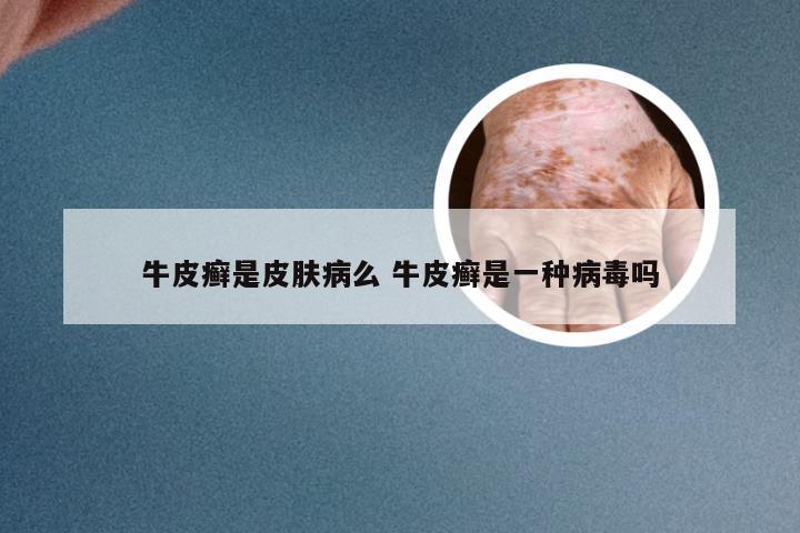 牛皮癣是皮肤病么 牛皮癣是一种病毒吗