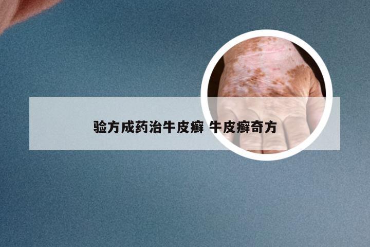 验方成药治牛皮癣 牛皮癣奇方