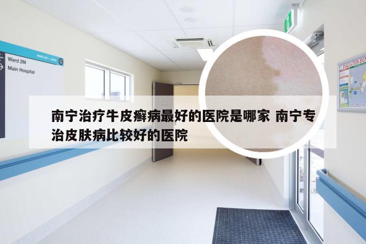 南宁治疗牛皮癣病最好的医院是哪家 南宁专治皮肤病比较好的医院