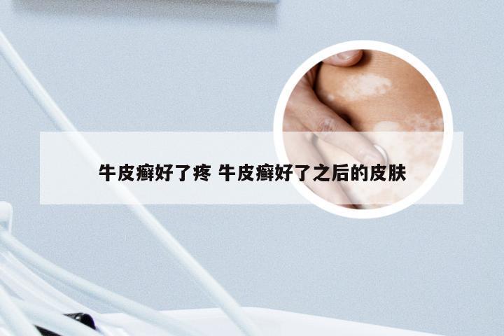 牛皮癣好了疼 牛皮癣好了之后的皮肤