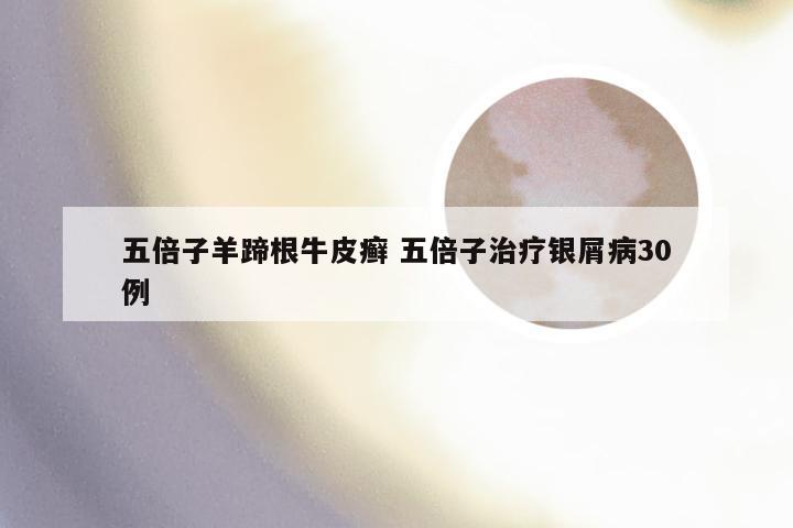 五倍子羊蹄根牛皮癣 五倍子治疗银屑病30例