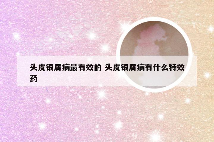 头皮银屑病最有效的 头皮银屑病有什么特效药