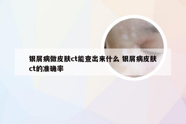 银屑病做皮肤ct能查出来什么 银屑病皮肤ct的准确率