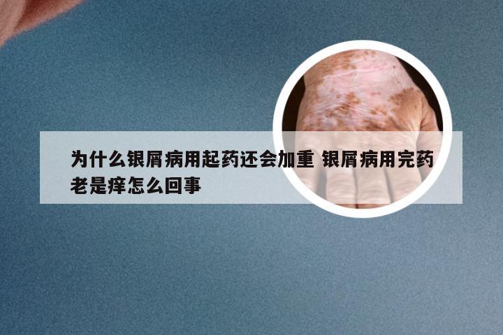 为什么银屑病用起药还会加重 银屑病用完药老是痒怎么回事