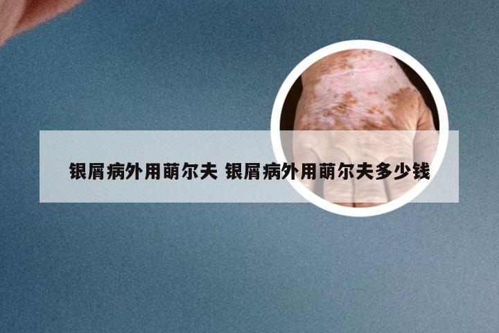 银屑病外用萌尔夫 银屑病外用萌尔夫多少钱
