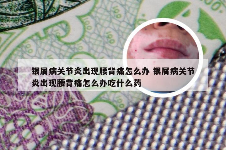 银屑病关节炎出现腰背痛怎么办 银屑病关节炎出现腰背痛怎么办吃什么药