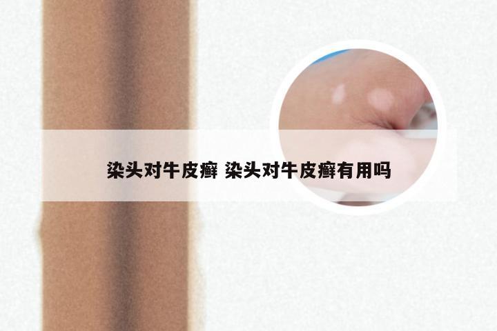 染头对牛皮癣 染头对牛皮癣有用吗