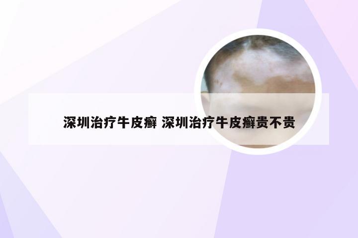 深圳治疗牛皮癣 深圳治疗牛皮癣贵不贵