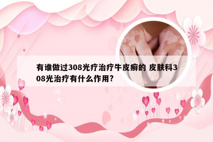 有谁做过308光疗治疗牛皮癣的 皮肤科308光治疗有什么作用?