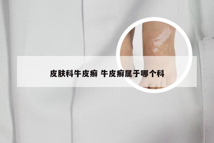 皮肤科牛皮癣 牛皮癣属于哪个科