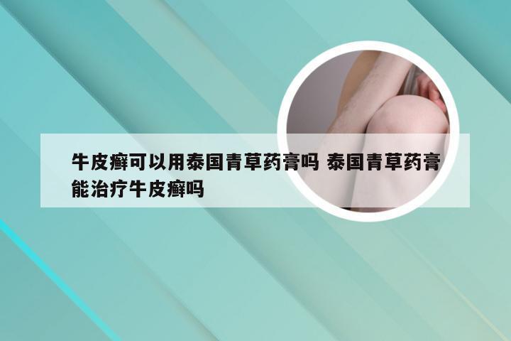 牛皮癣可以用泰国青草药膏吗 泰国青草药膏能治疗牛皮癣吗