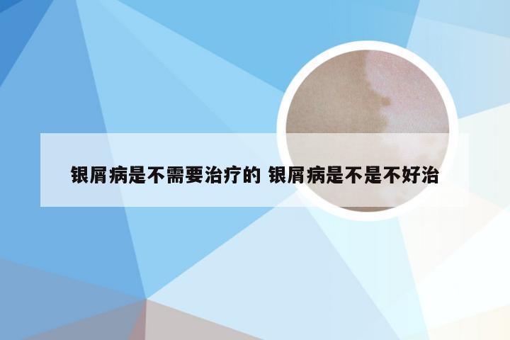 银屑病是不需要治疗的 银屑病是不是不好治