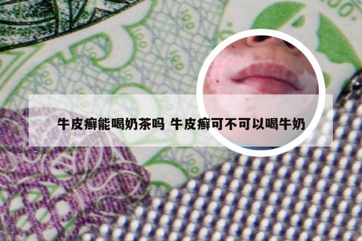 牛皮癣能喝奶茶吗 牛皮癣可不可以喝牛奶