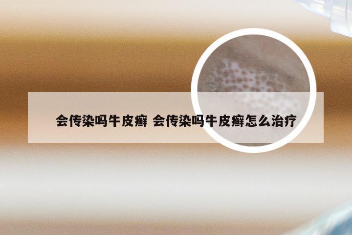 会传染吗牛皮癣 会传染吗牛皮癣怎么治疗