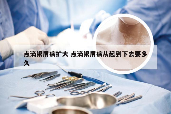 点滴银屑病扩大 点滴银屑病从起到下去要多久