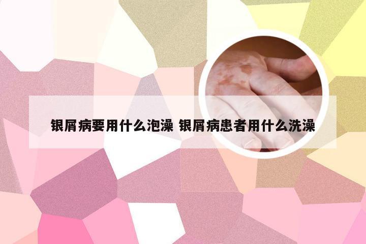 银屑病要用什么泡澡 银屑病患者用什么洗澡