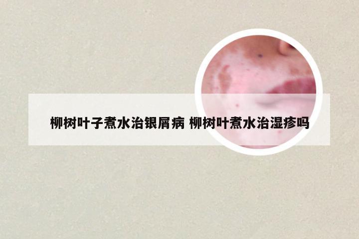 柳树叶子煮水治银屑病 柳树叶煮水治湿疹吗