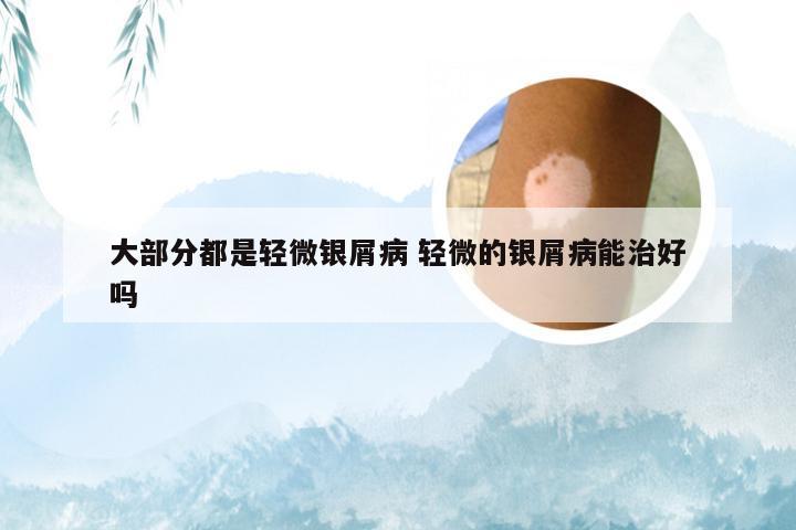大部分都是轻微银屑病 轻微的银屑病能治好吗
