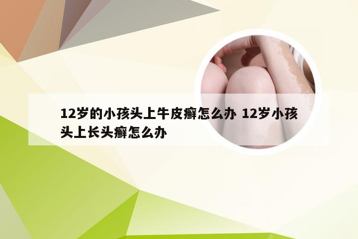 12岁的小孩头上牛皮癣怎么办 12岁小孩头上长头癣怎么办