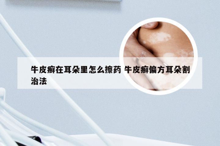 牛皮癣在耳朵里怎么擦药 牛皮癣偏方耳朵割治法